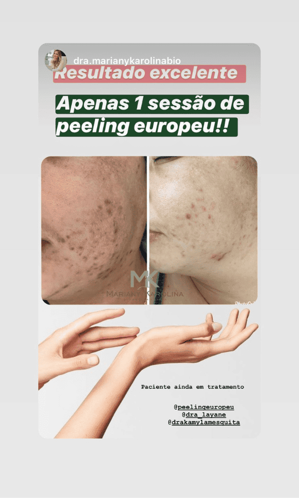 Antes x Depois do Peeling