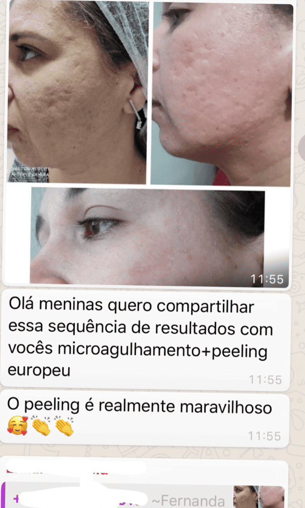 Antes x Depois do Peeling