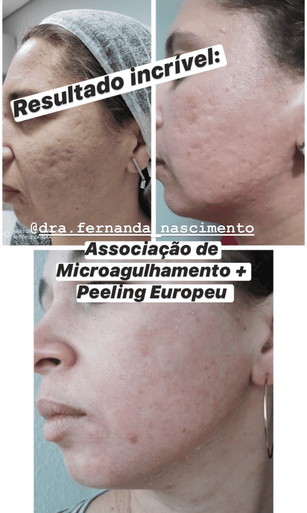 Antes x Depois do Peeling