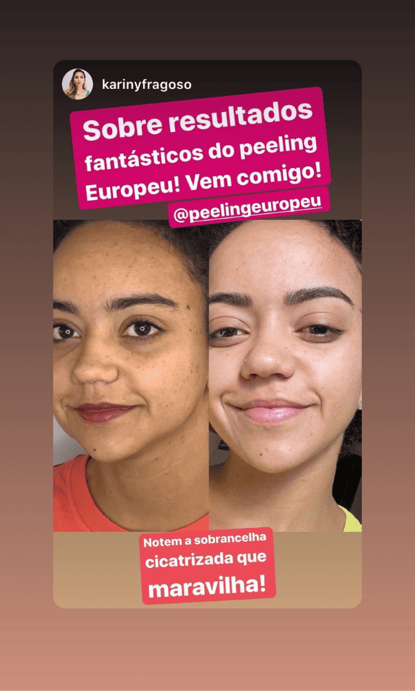 Antes x Depois do Peeling