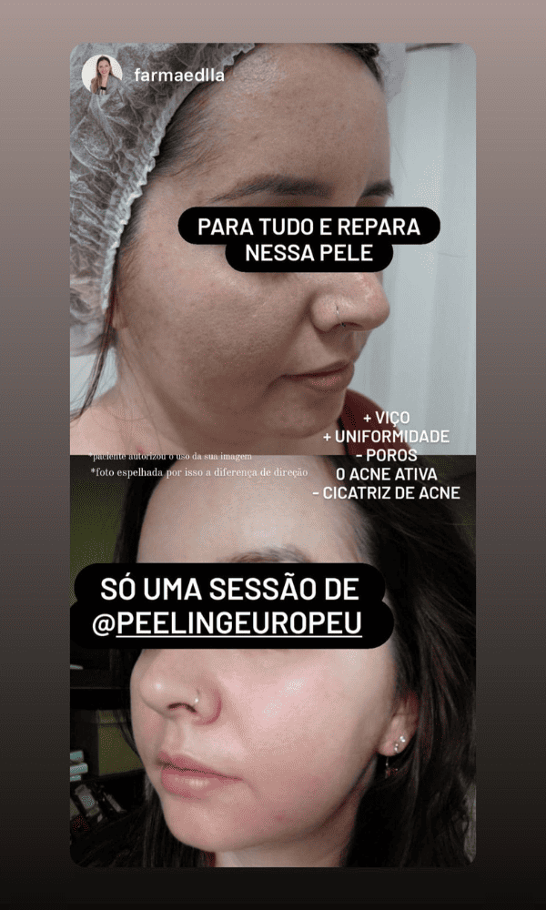 Antes x Depois do Peeling