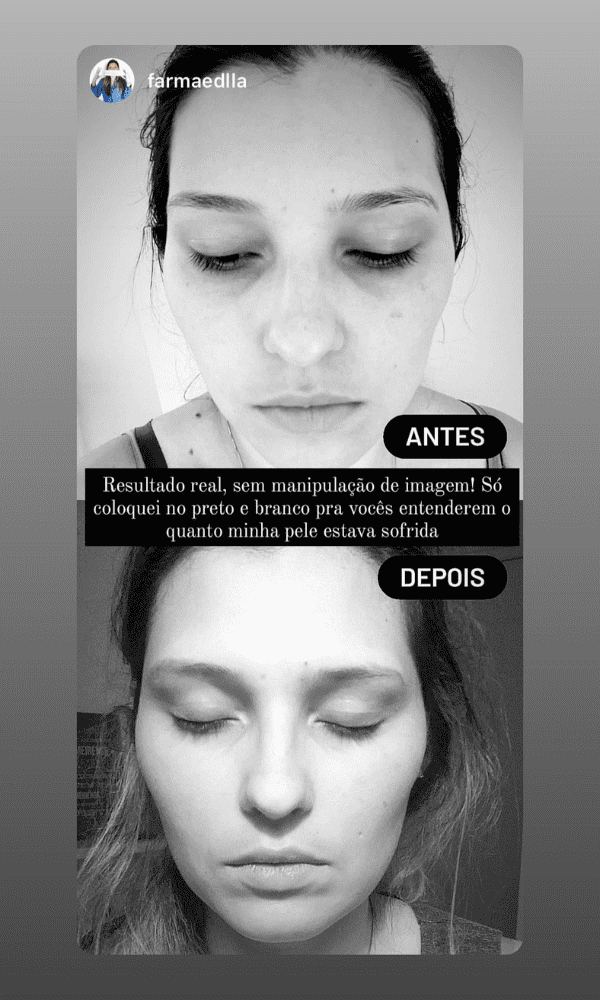 Antes x Depois do Peeling